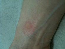 木村友泉のオリーブログ-発赤01