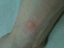 木村友泉のオリーブログ-発赤02