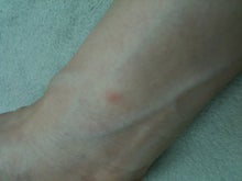 木村友泉のオリーブログ-発赤03