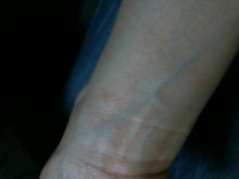 木村友泉のオリーブログ-発赤04